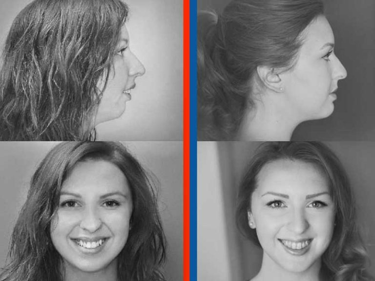 Overbite correction reference