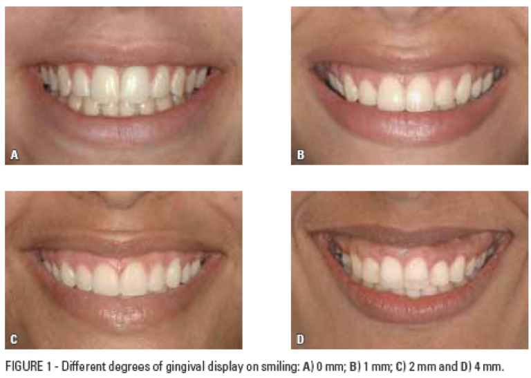 Gummy smile correction reference