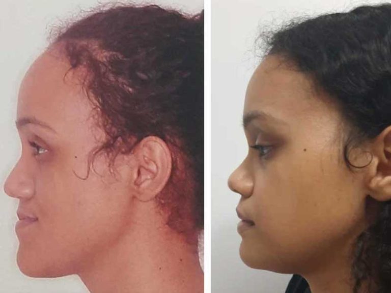 Underbite correction reference